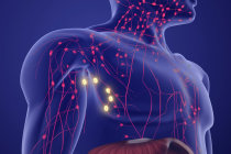 Linfoma de Hodgkin: uma neoplasia com elevado potencial de cura Linfoma de Hodgkin: uma neoplasia com elevado potencial de cura
