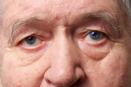 Demência LATE: quando o declínio cognitivo não é Alzheimer