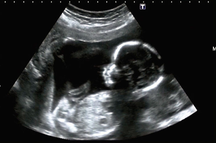 Fatores de restri&ccedil;&atilde;o ao crescimento intrauterino