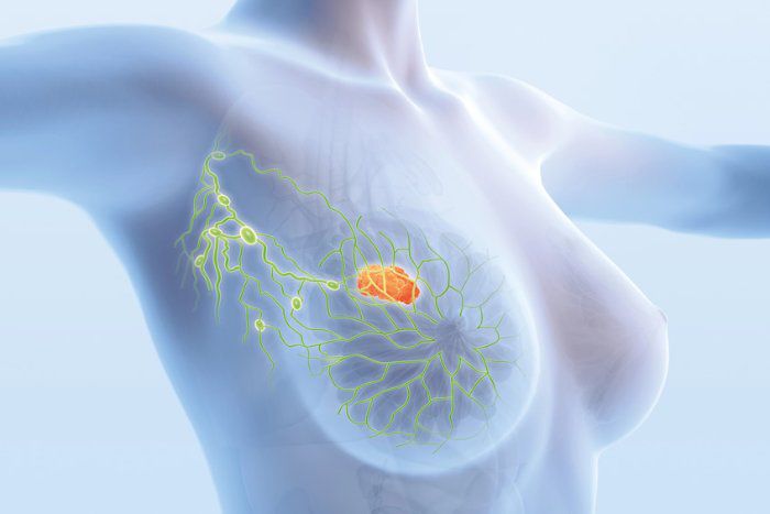 Mastectomia: entenda a cirurgia, a reconstru&ccedil;&atilde;o e os cuidados ap&oacute;s o procedimento