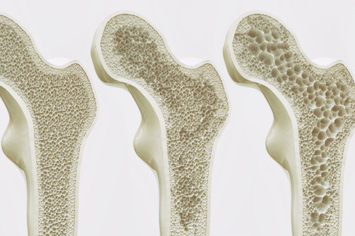 6 maneiras de proteger seus ossos contra a osteoporose e evitar fraturas