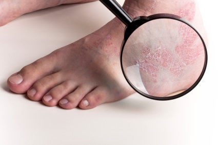A psor&iacute;ase n&atilde;o &eacute; contagiosa. Conhe&ccedil;a mais sobre esta condi&ccedil;&atilde;o.