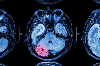Acidente vascular cerebral em jovens