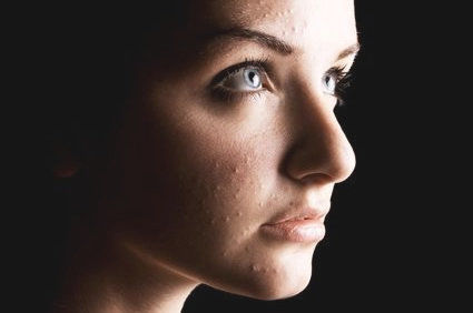 Acne na mulher adulta
