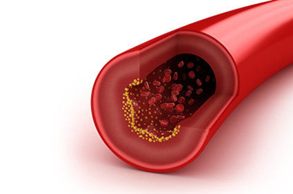 Arteriografia ou angiografia: como &eacute; o exame? Como se preparar? Quando deve ser realizado? Quais os riscos?