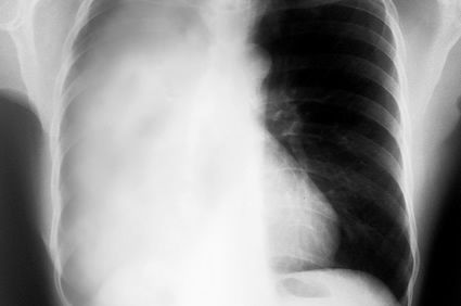 Atelectasia pulmonar: o que &eacute; isso?