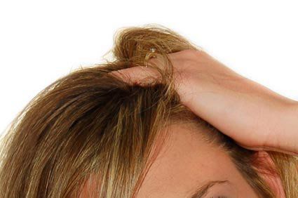 Caspas: o que s&atilde;o? Quais as causas, tratamento, preven&ccedil;&atilde;o e evolu&ccedil;&atilde;o?