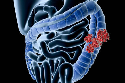 Colonoscopia: como é o exame? Quando deve ser realizado? Para que serve? Quais são os riscos e benefícios?