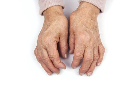 Como &eacute; a osteoartrite?
