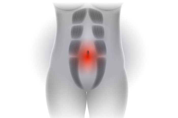 Di&aacute;stase abdominal