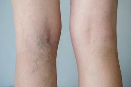 Doen&ccedil;as das veias