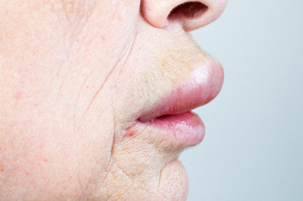 Edema de Quincke: o que &eacute; isso?