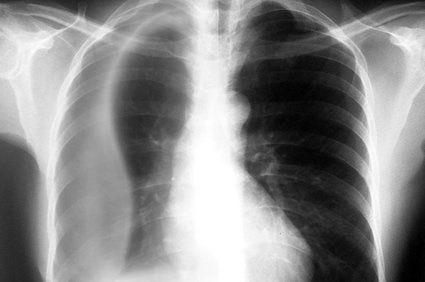 Empiema pleural ou pus na cavidade pleural: o que &eacute; isso? Tem jeito de evitar?