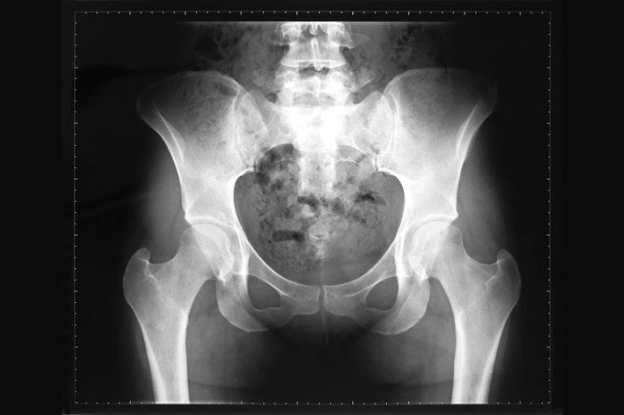 Fragilidade &oacute;ssea inexplicada? Pode ser displasia fibrosa