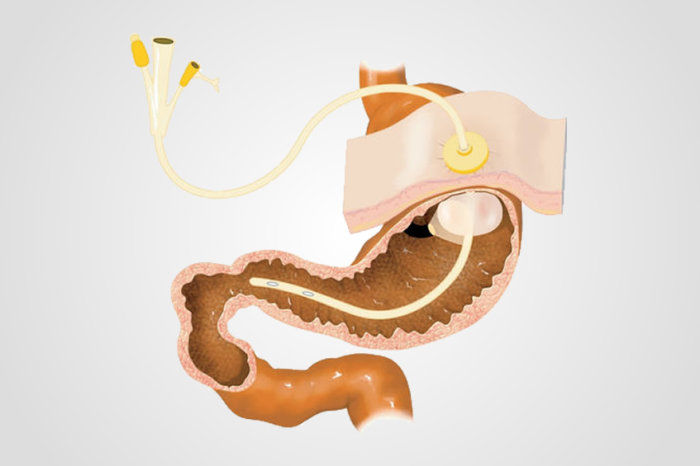 Gastrostomia - como &eacute; o procedimento? Quando deve ser feita?