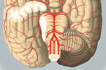 Insufici&ecirc;ncia vertebrobasilar: o que &eacute; isso?