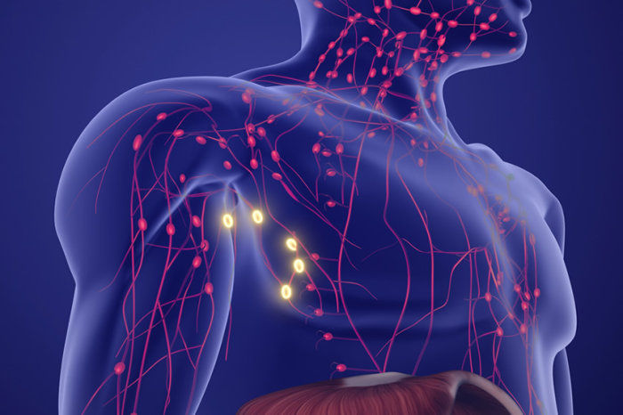 Linfoma de Hodgkin: uma neoplasia com elevado potencial de cura