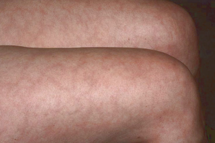 Livedo reticular