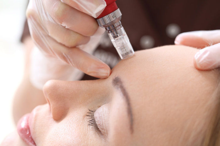 Microagulhamento no tratamento dermatológico
