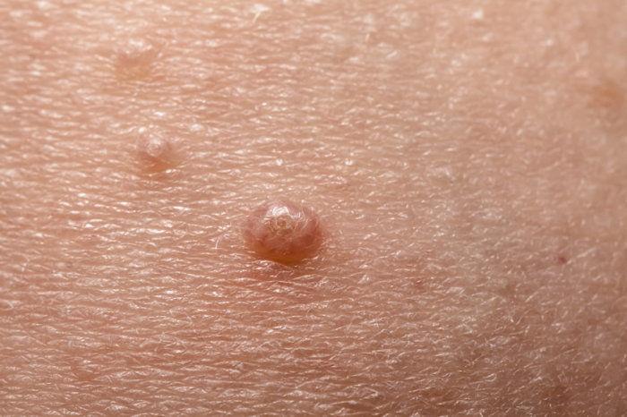 Molusco contagioso - conhe&ccedil;a essa infec&ccedil;&atilde;o de pele