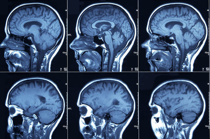O glioma e as suas caracter&iacute;sticas