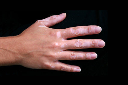 O que &eacute; vitiligo?