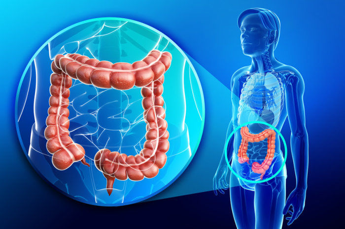Pancolite - O que &eacute;? Como fazer o diagn&oacute;stico e o tratamento? Tem preven&ccedil;&atilde;o?