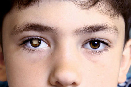 Retinoblastoma - o que devemos saber?