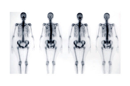 Saiba mais sobre a cintilografia &oacute;ssea: para que serve, quais os riscos do exame, como &eacute; feito?