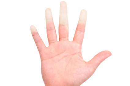 Síndrome de Raynaud: como ela é?