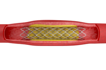 Stent - O que &eacute;? Quem deve colocar? Como &eacute; o procedimento? Quais as poss&iacute;veis complica&ccedil;&otilde;es?