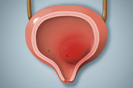 Ureterocele: causas, sintomas, diagn&oacute;stico, tratamento e poss&iacute;veis complica&ccedil;&otilde;es