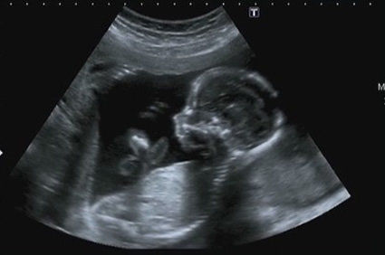 V&aacute;lvula da uretra posterior