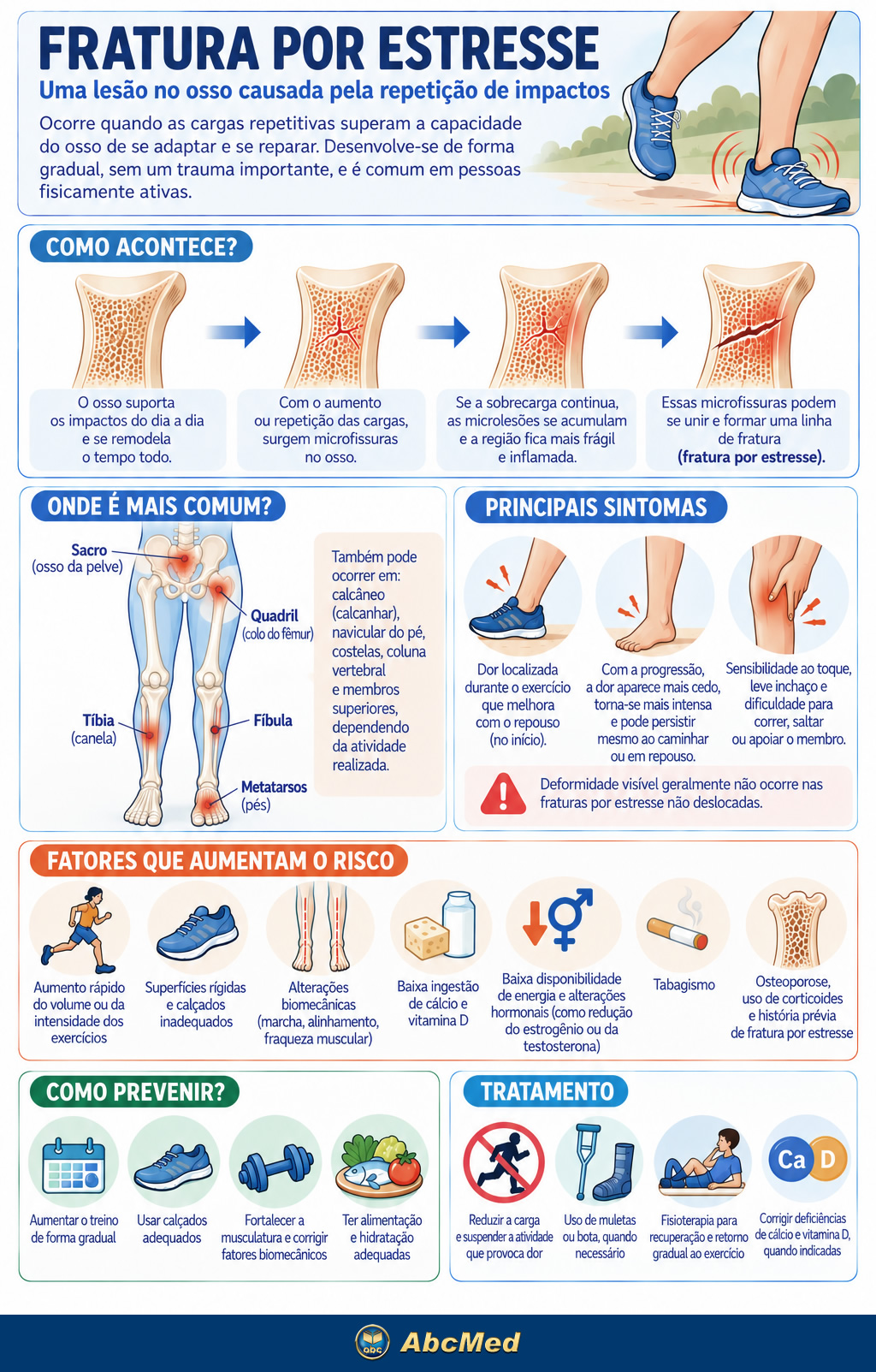 Infográfico - Fratura por estresse Infográfico - Fratura por estresse