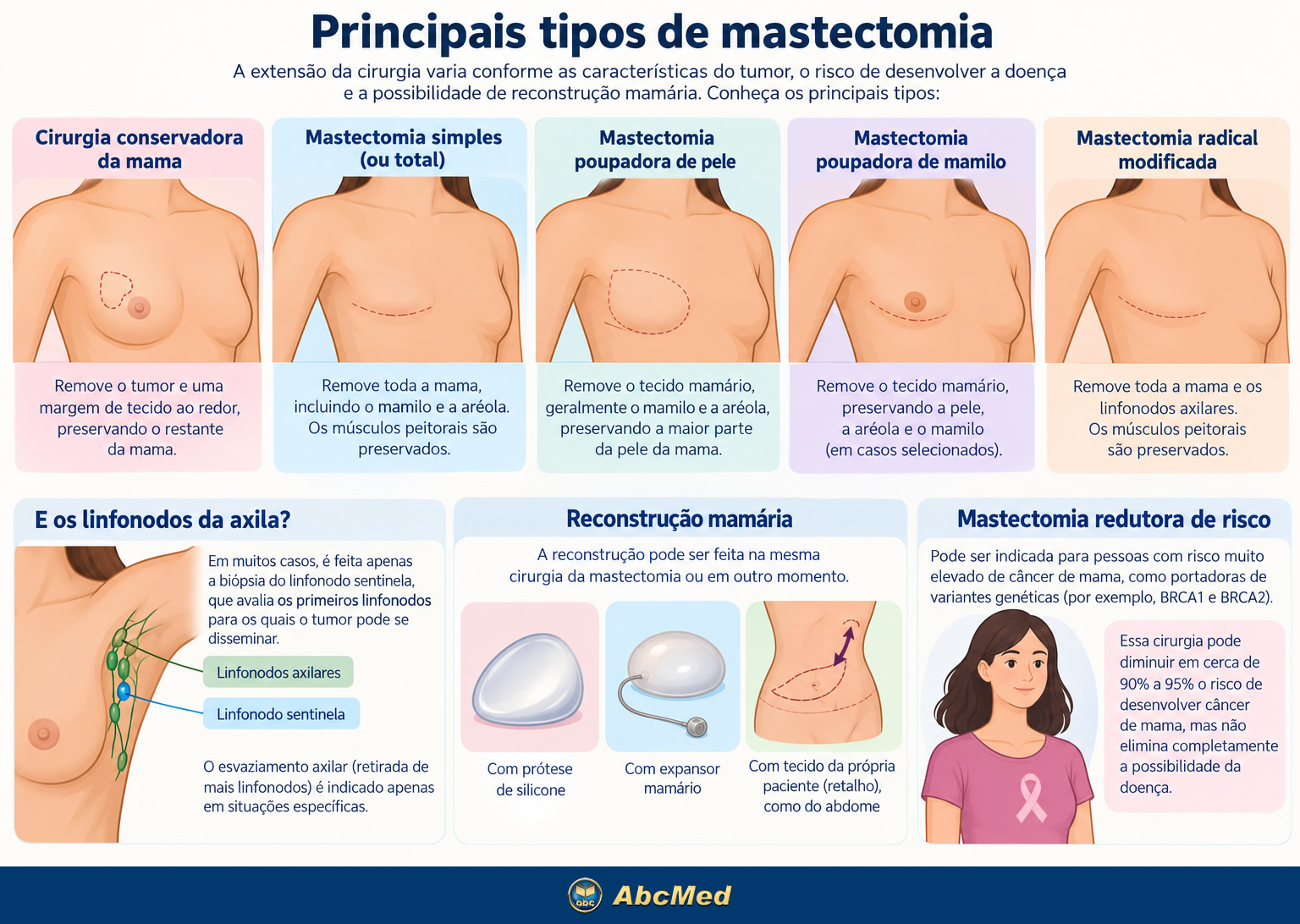 Infográfico - Mastectomia