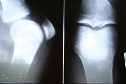 Hiperparatireoidismo: tipos, defini&ccedil;&atilde;o, causas, sintomas, diagn&oacute;stico, tratamento e preven&ccedil;&atilde;o